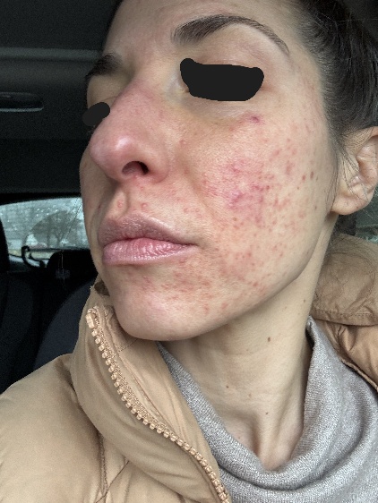 rosacea-before